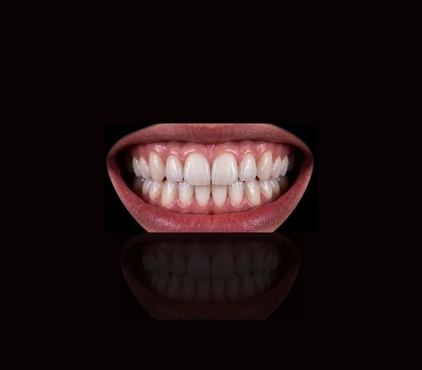 Smile Makeover