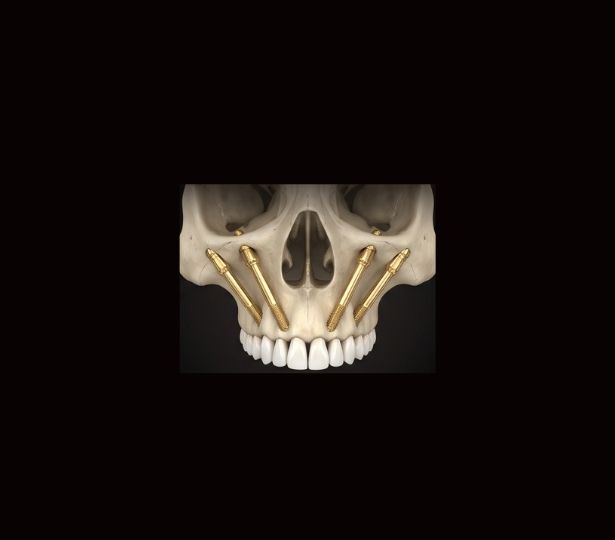 Zygomatische Implantate